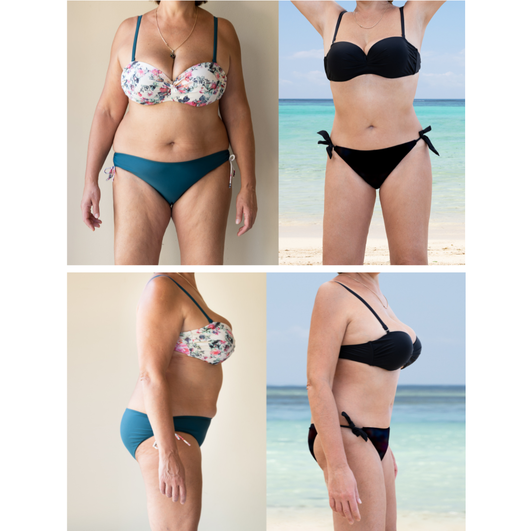 photos avant-après d'une femme senior en maillot de bain. on voit qu'elle a perdu beaucoup de gras.